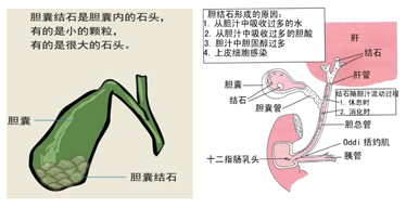 微創保膽取石---膽囊結石病人的福音