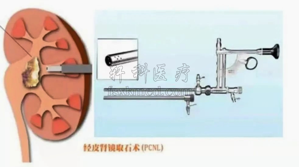 圖2-1  經(jīng)皮腎鏡.jpg